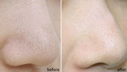 撕黑头视频,专业视频教你轻松告别毛孔堵塞